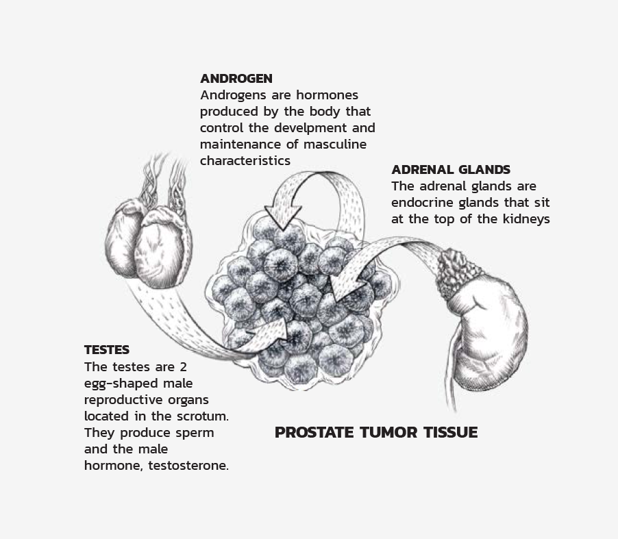 Understanding prostate cancer